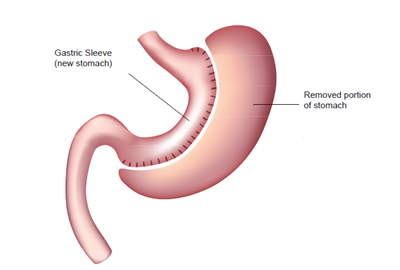 Gastric Sleeve (Sleeve Gastrectomy) Surgery