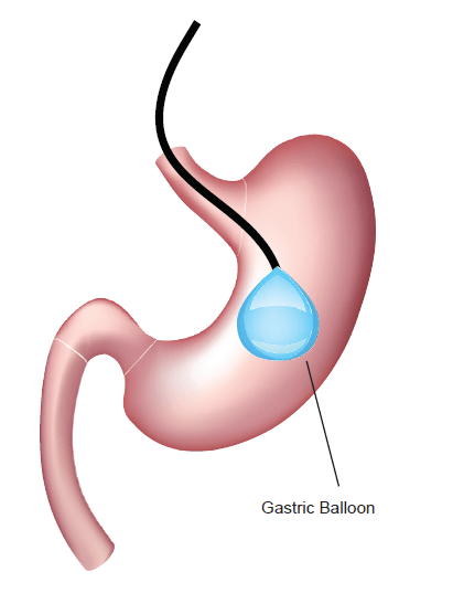 Illustration of Gastric balloon surgery