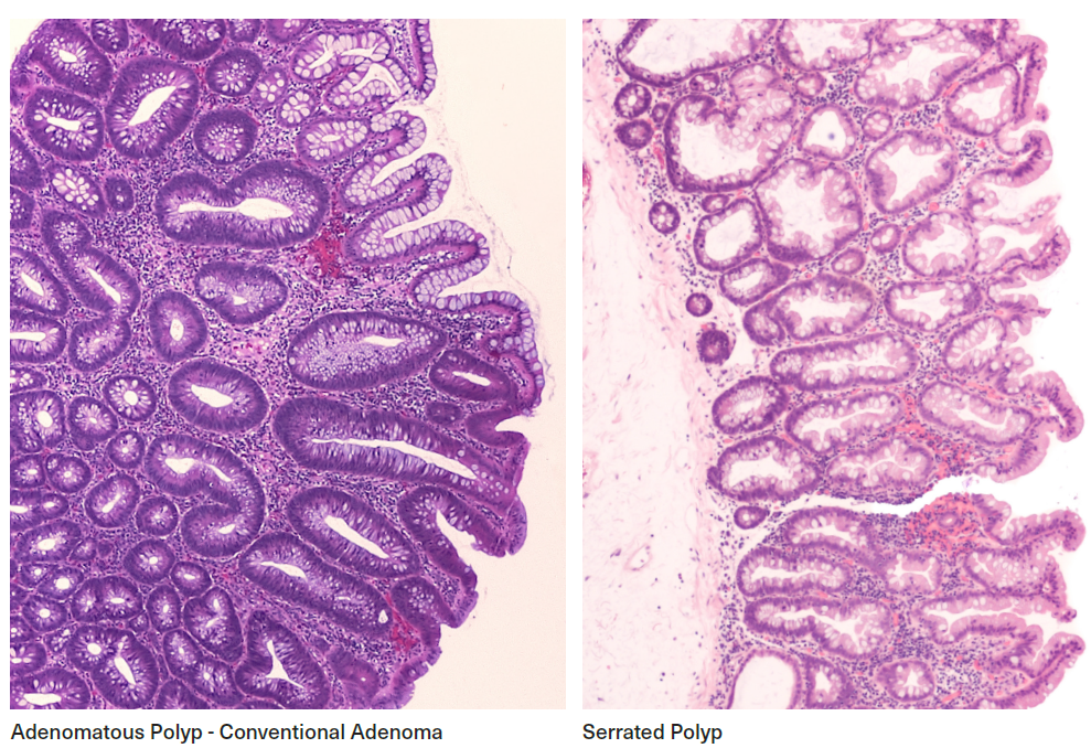 Colorectal Polyps As Precursors To Colorectal Malignancy | RGA