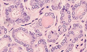 papillary thyroid cancer psammoma bodies